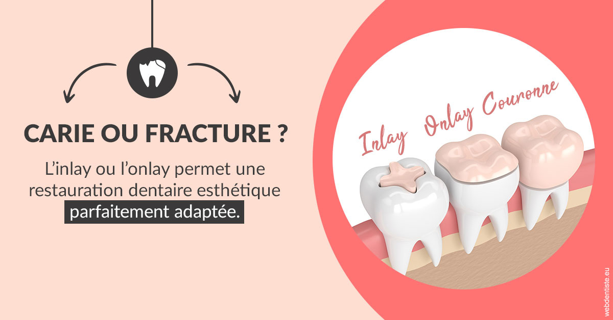 https://dr-julia-olivier.chirurgiens-dentistes.fr/T2 2023 - Carie ou fracture 2