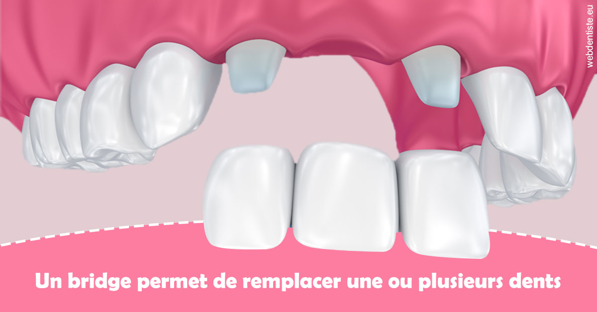 https://dr-julia-olivier.chirurgiens-dentistes.fr/Bridge remplacer dents 2