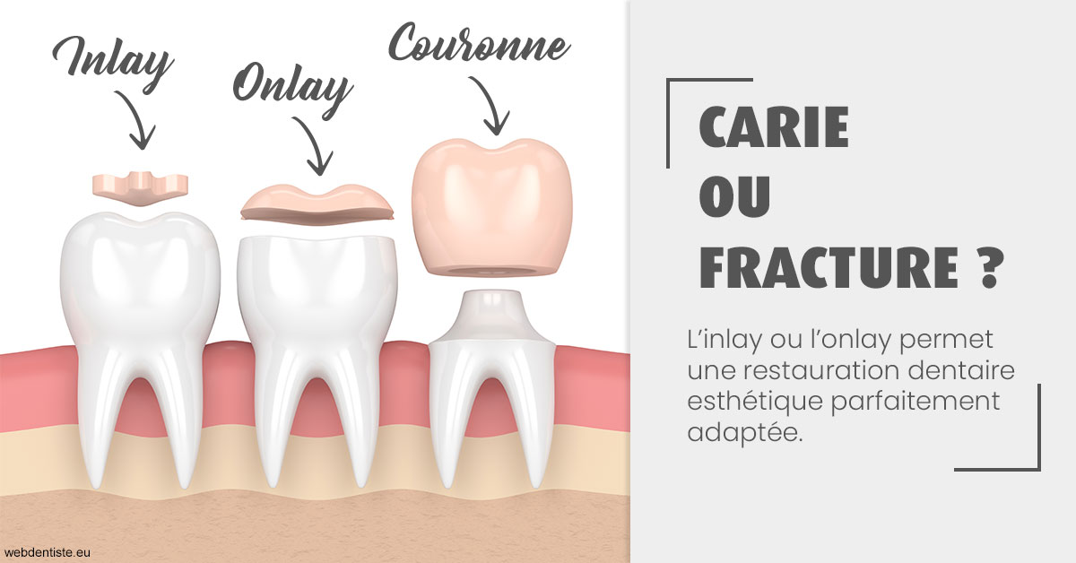 https://dr-julia-olivier.chirurgiens-dentistes.fr/T2 2023 - Carie ou fracture 1