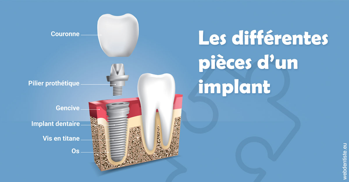 https://dr-julia-olivier.chirurgiens-dentistes.fr/Les différentes pièces d’un implant 1